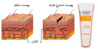 کرم رفع ترک های پوستی ناشی از چاقی و لاغری گاتیو ایتالیا 100 میل